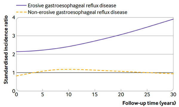 非糜烂性胃食管反流患者食管腺癌发病率研究