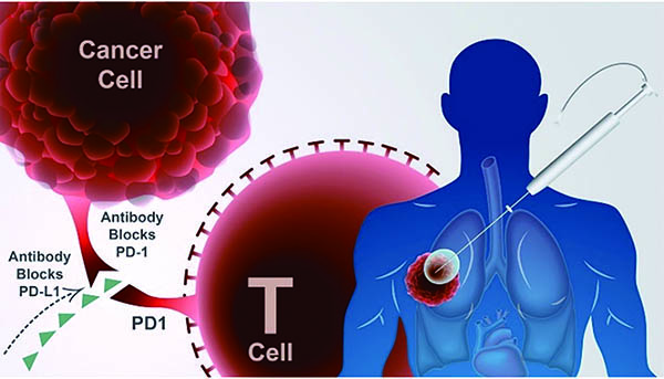 可切除的早期NSCLC 围手术期免疫治疗可改善患者预后 