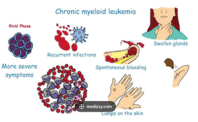 新发的、费城染色体阳性CML-CP asciminib继续保持优于最佳标准治疗的优势