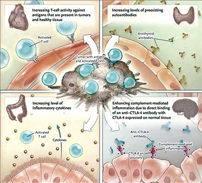 ICI治疗的晚期NSCLC 轻度irAE者预后良好，重度irAE者预后不良