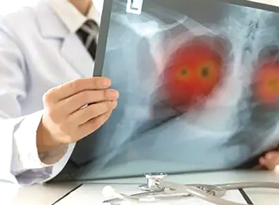 不可切除PD-L1 TPS≥50%局部晚期NSCLC 帕博利珠单抗联合含铂化疗或为可行的无放疗替代策略