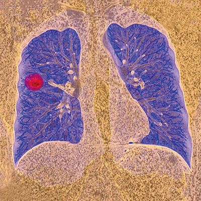 经治的ES-SCLC I-DXd 12 mg/kg q21疗效可期且安全性可控