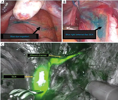 国人宫颈癌研究《新英格兰医学杂志》发表