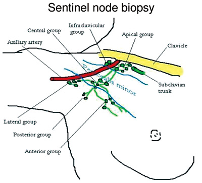 早期乳腺癌中省略前哨淋巴结活检的现实考量​