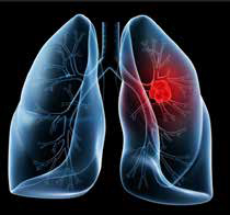 389-390期《全球肿瘤快讯》-20.jpg 389-390期《全球肿瘤快讯》-20.jpg