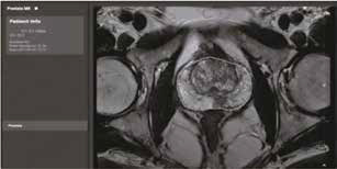 仅使用MRI监测前列腺癌可靠性研究