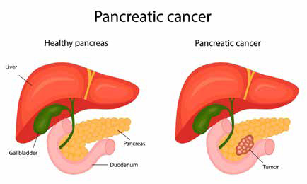 389-390期《全球肿瘤快讯》-45.jpg 389-390期《全球肿瘤快讯》-45.jpg