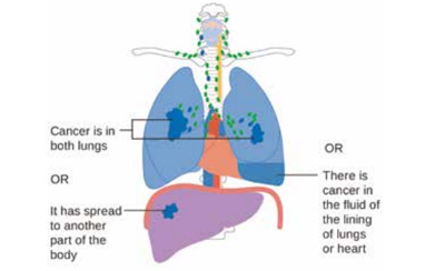 R0切除且为pN2期NSCLC 化疗序贯放疗辅助治疗改善生存更好