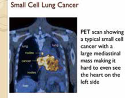 一线治疗广泛期小细胞肺癌    氨柔比星联合卡铂不优于标准治疗