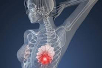 非遗传性乳腺癌对侧乳房预防性切除术患者的心理结局