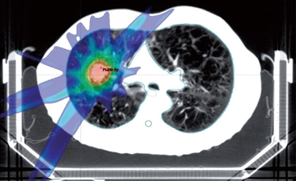 T1~3N0M0期NSCLC 立体定向放疗后或不宜辅助化疗