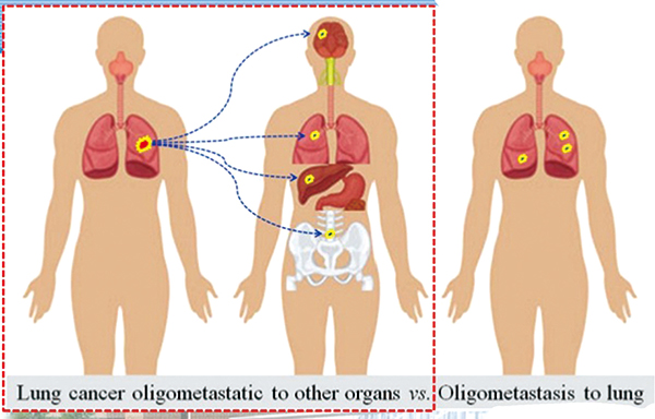 肺外转移灶≤3处NSCLC 局部巩固治疗可延长生存期
