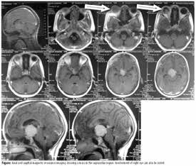 视网膜母细胞瘤 分析眼组织病理特征有助于确定转移风险