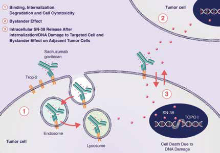 转移性三阴性乳腺癌 Sacituzumab Govitecan在某些患者中优于化疗