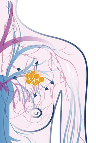 ASCO 转移性乳腺癌化疗和靶向治疗指南更新