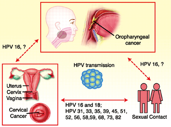 HPV相关肿瘤 解剖部位分层或可预测预后