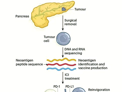 胰腺癌mRNA疫苗治疗研究突破