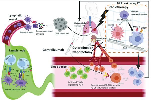 可切除的ⅢA/ⅢB期NSCLC 卡瑞利珠单抗联合新辅助化疗显著改善pCR