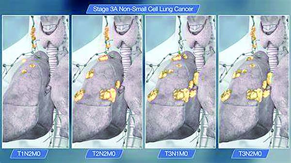 Ⅱ~ⅢA期非鳞状NSCLC PemP辅助化疗疗效与NP相似