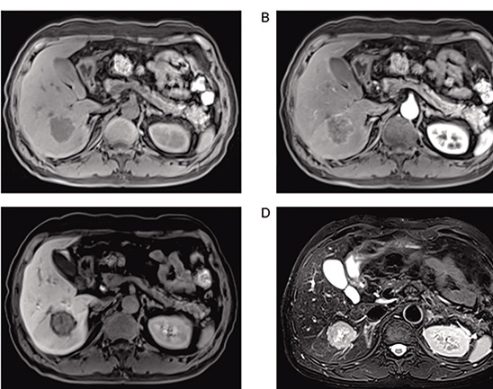 结直肠癌肝转移 局部治疗时建议增强MRI加增强CT