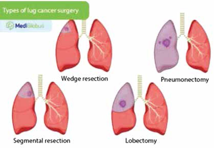 纯实性NSCLC 肺段切除术生存获益因年龄和性别而异