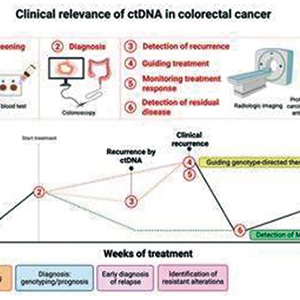 ctDNA分析时机可指导结直肠癌辅助治疗