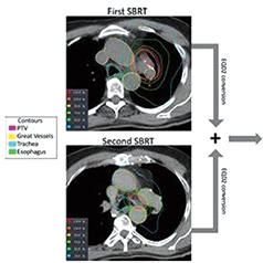 复发性NSCLC 胸部再放疗和巩固性免疫疗法均可选