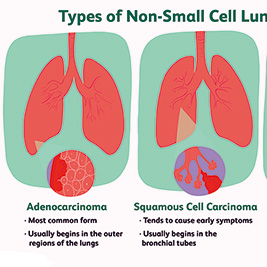 EGFR ex20ins突变的NSCLC 后线应用zipalertinib有效且安全性可控
