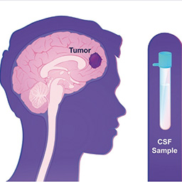CSF-BAM仅凭脑脊液就可识别中枢神经系统肿瘤