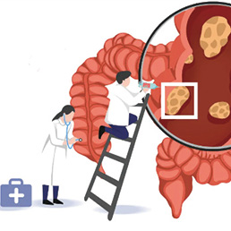 早期低位直肠癌 基于免疫治疗的全程新辅助治疗有助于实现器官保留