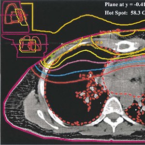 中等风险乳腺癌患者 术后胸壁放疗不改善预后