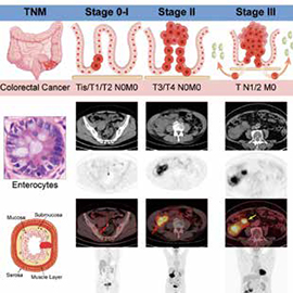 左侧RAS/BRAF野生型转移性结直肠癌 早期[18F]FDG PET/CT或可作预测性生物标志物​