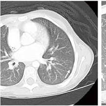 仅肺转移的、良性肾母细胞瘤患儿 1q增益的预后价值优于肺部肿瘤负荷