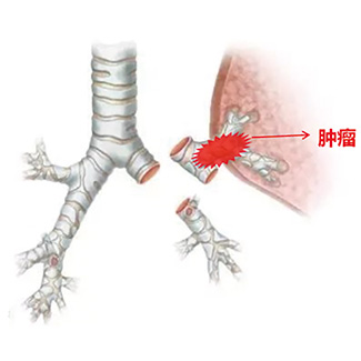 纯实性ⅠA期NSCLC 肺叶切除术仍为标准治疗