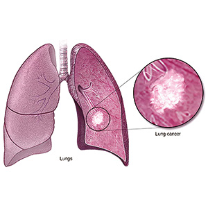 经治的HER2过表达NSCLC 德曲妥珠单抗单药即有效