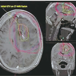 复发性胶质母细胞瘤再放疗时 靶区勾画仍首选T1加权对比增强MRI