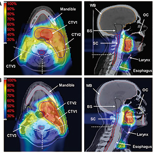 调强质子放疗或为口咽癌的标准治疗