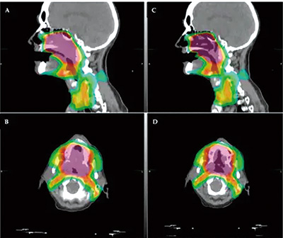 为避免嗅觉障碍，头颈癌的最佳放疗剂量宜<22 Gy