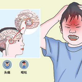 儿童癌症幸存者面临长期的脑膜瘤风险