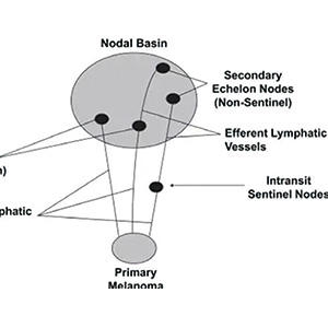 黑色素瘤 前哨淋巴结活检者死亡和复发风险较低