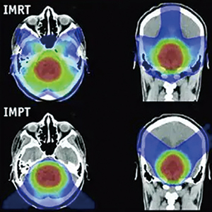 局部晚期口咽鳞状细胞癌 IMPT对比IMRT远期生活质量和生存结局均相似