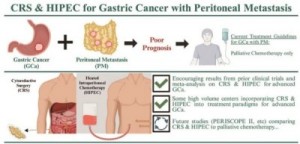 腹膜转移胃癌PERISCOPE Ⅱ研究