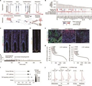 研究发现肠癌转移的分子开关